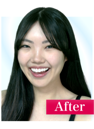 施術後の歯の色のイメージ