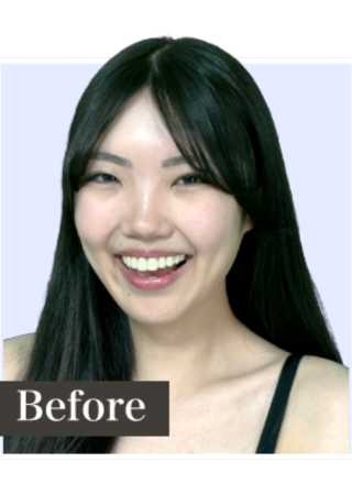 施術前の歯の色のイメージ